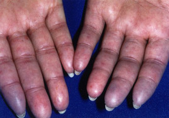 Scleroderma and cold hands