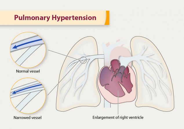 Pulmonary Hypertension and cold hands